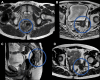 T2-weighted MR images of border types in locally recurrent rectal
cancer. (A) Non–contrast-enhanced T2-weighted transverse MR image of
central compartment involvement in a 67-year-old male patient. (B)
Non–contrast-enhanced T2-weighted transverse MR image of anterior
compartment involvement in a 77-year-old male patient. (C)
Non–contrast-enhanced T2-weighted sagittal MR image of posterior
compartment involvement in a 46-year-old male patient. (D)
Non–contrast-enhanced T2-weighted transverse MR image of lateral
compartment involvement in a 58-year-old male patient. Tumors are circled in
blue.