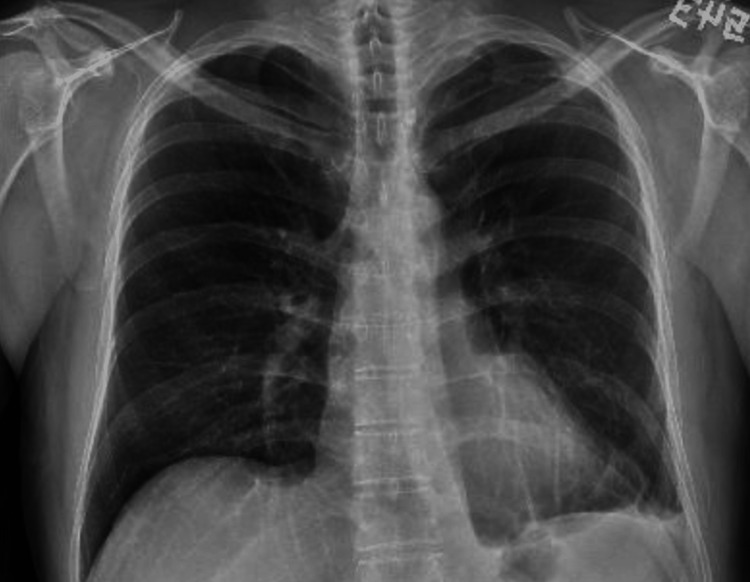 An Unusual Case of Hemothorax in - Cureus 0016 00000055084 I03