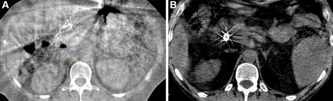 (A) Representative axial cone-beam CT (CBCT) image acquired with a conventional linear accelerator. (B) Representative axial image acquired using iterative CBCT reconstruction.