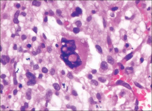 Nuclear vacuolization: Giant Lochkern-like cells - PMC