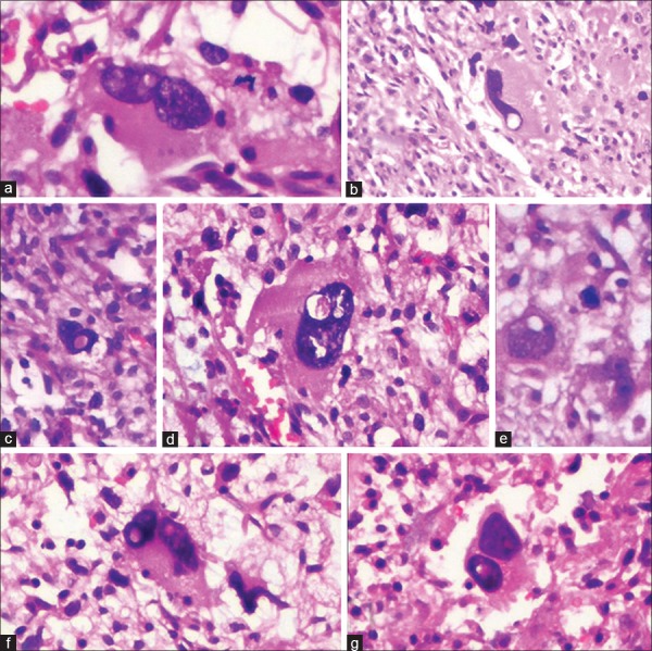 Nuclear vacuolization: Giant Lochkern-like cells - PMC