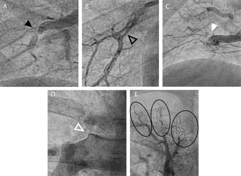 Angiographic depictions of the different chronic thromboembolic lesion subtypes: (A) ring lesion (black arrow); (B) web lesion (black outlined arrow); (C) subtotal occlusion lesion (white arrow); (D) total occlusion lesion (white outlined arrow); and (E) tortuous lesions (black circles)