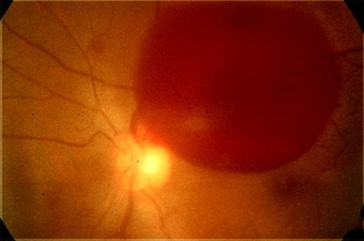 Valsalva retinopathy in a young healthy individual - PMC