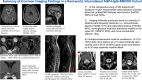 Summary of common imaging findings in a real-world, international
cohort with aquaporin-4 immunoglobulin G–seropositive (AQP4-IgG+)
neuromyelitis optica spectrum disorder (NMOSD). An enlarged image (arrows)
shows the conus region of the spinal cord (SC). LETM = longitudinally
extensive myelitis, NETM = nonlongitudinal extensive transverse
myelitits.