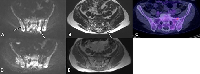 Images in a 67-year-old woman show posttreatment resolution of a lesion detected at whole-body MRI but not PET/CT, thereby ruling out a false-positive finding. (A) A focal lesion within the left posterior sacrum seen at axial b900 diffusion-weighted imaging (white arrow) and (B) Dixon T1-weighted imaging (arrow) was observed at (C) corresponding fluorine 18 fluorodeoxyglucose PET/CT (50% bone marrow infiltration by myeloma cells; IgG λ paraprotein, 62 g/L; serum free κ light chains, 6 mg/L; λ light chains, 47 mg/L; light chain ratio, 0.13). Increased signal from background marrow (black arrow in A) relative to muscle also suggested diffuse infiltration that was not detected at PET/CT. (D) Axial b900 diffusion-weighted image after chemotherapy and (E) Dixon T1-weighted image show the lesion had resolved. (At time of scan, there was < 1% bone marrow infiltration; paraprotein, 2 g/L; κ light chains, 9 mg/L; λ light chains, 6 mg/L; and light chain ratio, 1.5; participant reached immunofixation-negative complete remission a few months later without further intervention).