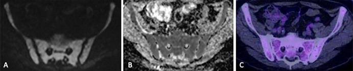 Images in a 71-year-old man show diffuse infiltration detected at MRI but not fluorodeoxyglucose (FDG) PET/CT. (A) Diffuse increased signal throughout the pelvic bone marrow relative to background tissue on axial b900 diffusion-weighted image and intermediate apparent diffusion coefficient (638 mm2/sec) on the (B) apparent diffusion coefficient map indicates diffuse hypercellularity, suggesting diffuse infiltration. However, (C) the corresponding FDG PET/CT image did not show an abnormality. Bone marrow sampling confirmed 85% infiltration of the bone marrow by myeloma.