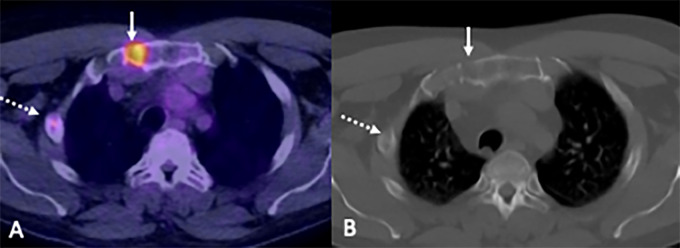 Images in a 54-year-old man show disease detection at fluorine 18 fluorodeoxyglucose (FDG) PET/CT. (A) Focal increased FDG uptake (solid arrow) corresponds with bone destruction on the CT-only image. (B) A second subtle rib lesion was also observed (dashed arrow) (10% bone marrow infiltration by myeloma cells; paraprotein not detectable; serum free κ light chains, 14 mg/L; λ light chains, 1820 mg/L; light chain ratio, 0.01).