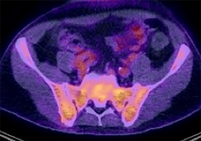 Image in a 59-year-old man shows diffuse disease at fluorodeoxyglucose (FDG) PET/CT. There is increased FDG uptake on fused PET/CT images relative to background tissues (80% bone marrow infiltration by myeloma cells; IgG κ paraprotein, 69 g/L; serum free κ light chains, 7 mg/L; λ light chains, 39 mg/L; light chain ratio, 0.02).