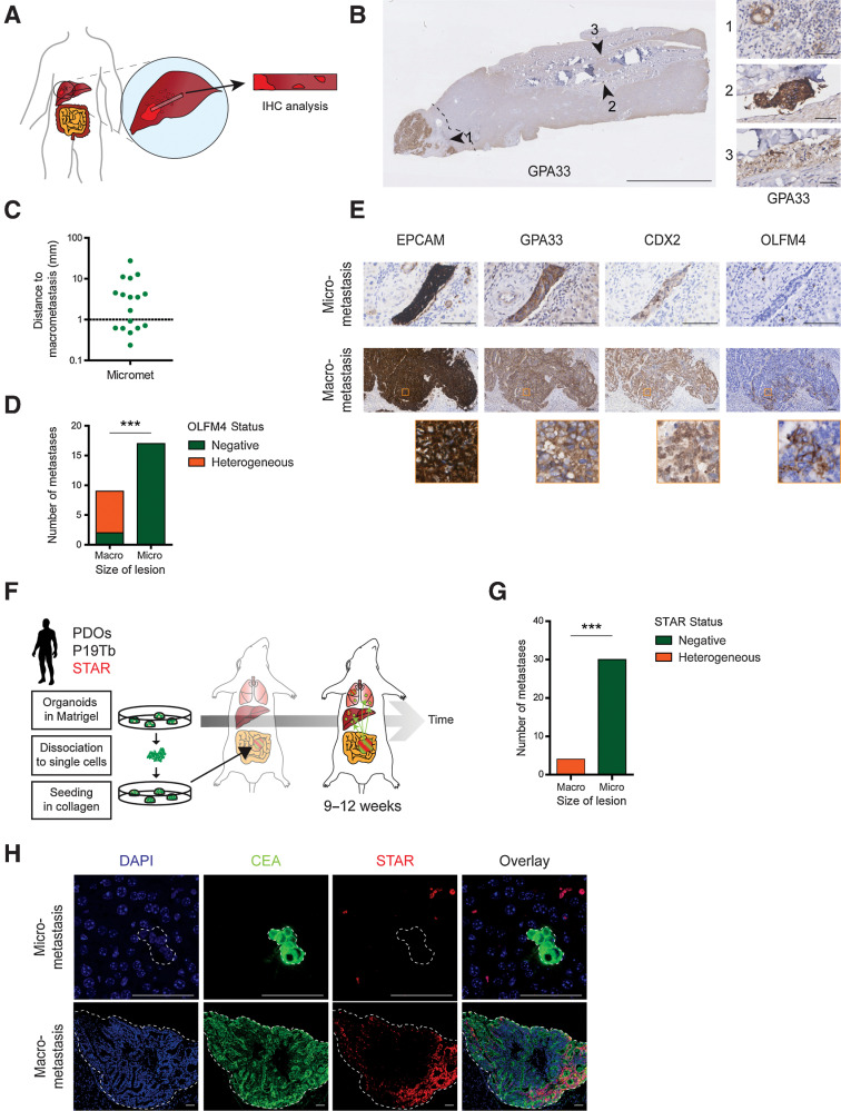 Figure 1. Liver micrometastases of human colorectal cancers (CRC) are devoid of classical SC markers. A, Graphical representation of liver tissue strips extending from macrometastases into adjacent liver tissue. B, Liver tissue strip stained for GPA33 to identify macro- and micrometastases (arrowheads). Dashed lines indicates 1 mm distance to macrometastasis. Scale bar, 5 mm (50 µm in close-ups). C, Distance of identified micrometastases to their respective macrometastasis. Each dot represents one lesion. D, Bar graph summarizing OLFM4 expression patterns in all macro- and micrometastases as either completely absent (green) or heterogeneous (orange). E, Representative IHC stainings of a macro- and micrometastasis of the same patient. Macrometastasis shows heterogeneous OLFM4 expression. Close-ups, orange boxes. Scale bars, 100 µm. F, Experimental setup for spontaneous metastasis formation in mice using orthotopic transplantation of human CRC PDOs with analysis after 9–12 weeks. G, Bar graph depicting the presence of STAR+ CSCs in liver macro- or micrometastases, identified and classified (size) through IHC against human CEA. H, Representative images related to G. STAR minigene is unique to xenotransplanted cancer line. Signal outside CEA-marked metastasis is background. Scale bars, 50 µm.