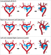 Edwards hypothetical arch model, assuming that the ductus arteriosus
connects to the respective arch proximal to the subclavian arteries. Formation
of the typical left aortic arch (top), a right arch with aberrant left
subclavian artery (middle), and our patient’s arch configuration (bottom)
with left arch, isolated right common carotid artery, and aberrant right
subclavian artery. Red indicates systemic arterial structures, light blue
indicates pulmonary arterial structures, dark blue indicates ductus arteriosus,
and black lines indicate the absorption points. AAo = ascending aorta, DAo =
descending aorta, L CC = left common carotid artery, L Sc = left subclavian
artery, PA = pulmonary artery, R Bc = right brachiocephalic artery, R CC = right
common carotid artery, R Sc = right subclavian artery.