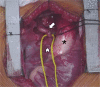 Intraoperative frontal image following sternotomy demonstrates the
isolated right common carotid artery (arrow, looped by yellow string) arising
off the right pulmonary artery (arrowhead). * = ascending
aorta.