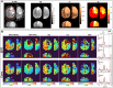 Absolute quantification of metabolites in the brain of a participant
with World Health Organization grade 3 mutant IDH1 anaplastic astrocytoma
(participant 1 with glioma in Table). (A) Axial anatomic fluid-attenuated
inversion recovery (FLAIR) image and proton density (PD), T1, and T2
parametric maps acquired with three-dimensional echo-planar time-resolved
imaging (EPTI). (B) Absolute concentration metabolic images for brain
metabolites (N-acetyl-aspartate [NAA] and N-acetyl-aspartyl-glutamate
[NAAG], glycerophosphocholine [GPC] and phosphocholine [PCh], glutamate
[Glu], and myo-inositol [Ins]) and the oncometabolite D-2-hydroxyglutarate
(2HG) produced using relaxation parameters measured with EPTI or assuming
conventional values from the literature (Conv). The spectra in B (black
line, measured spectrum; red line, LCModel fit) are from four brain
locations, including the tumor (arrow 1 in A), the infiltrating edge of the
tumor (arrows 2 and 3 in A), and normal-appearing brain (arrow 4 in A). The
good-quality spectra from the tumor, infiltrative edge, and normal-appearing
brain show a gradual transition from the tumor metabolic profile to the
normal brain metabolic profile. A.U. = arbitrary units.