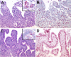 Figure 3. Sequential duodenal biopsies from a patient with allogeneic HSCT. (A) Duodenal biopsy with severe GVHD showing partial loss of surface epithelium (H&E) and increased numbers of apoptotic crypt epithelial cells (inset: cleaved caspase-3 staining showing apoptotic epithelial cells at the base of crypts). (B) Predominance of CD8+ T cells in the lamina propria with focal infiltration of the crypt epithelium (immunohistochemistry, APAAP method). (C) In contrast, duodenal biopsy in the same patient during NV infection shows villous blunting (H&E) and only a slight increase of apoptotic epithelial cells at the tip of the villi (inset: cleaved caspase-3) and (D) a massive increase of intraepithelial CD8+ T cells pronounced in the surface epithelium. Original magnifications, ×200 and ×600 (inset). Microscope: Olympus AX70 (Olympus); numeric aperture of objective lenses: ×20, 0.70 mm; ×60, 1.40. Stains: H&E (panels A and C); APAAP and streptavidin AP (panels B and D, inset). Camera: JVC KY-F70 (JVC); acquisition software: DISKUS; and software used for image processing: Adobe Photoshop 7.0 (Adobe Systems).
