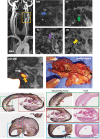 Fluorine 18–labeled sodium fluoride (18F-NaF) PET/MRI carotid
scans and ex vivo histologic analysis sample in a patient who experienced a
left hemispheric transient ischemic attack. MR angiograph in a 60-year-old
woman with left hemispheric transient ischemic attack shows a left carotid
artery stenosis of greater than or equal to 70% severity (box, MR
angiography [MRA] panel; arrow, time-of-flight [TOF] panel). MRI plaque
analysis was used to identify intraplaque hemorrhage (arrow, T1 panel),
lipid-rich necrotic core (arrow, T2 panel), and calcification (arrow, proton
density [PD] panel). 18F-NaF PET/MRI showed focal uptake in the region of
the intraplaque hemorrhage and lipid-rich necrotic core (orange arrow). The
carotid plaque was excised at operation. Cross-sectional images through the
carotid plaque are shown, with hematoxylin and eosin (H & E) and
Movat pentachrome stains. The red arrow indicates the thin fibrous cap, the
blue arrow highlights plaque erosion, the star denotes a rupture, the purple
arrow shows intraplaque hemorrhage with a thrombus, the yellow arrowheads
denote inflammation (shoulder and central regions), and the green arrowheads
indicate lipid-rich necrotic cores.
