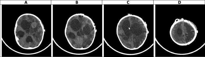 Evolution of neuroimaging findings in angioinvasive cerebral ...