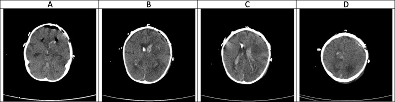 Evolution of neuroimaging findings in angioinvasive cerebral ...