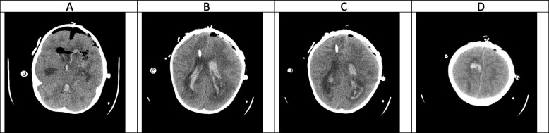 Evolution of neuroimaging findings in angioinvasive cerebral ...