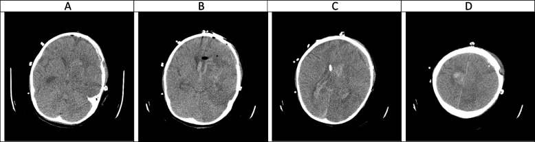 Evolution of neuroimaging findings in angioinvasive cerebral ...