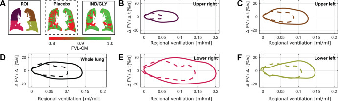 Flow-volume loops following treatment with placebo and IND-GLY in one patient. The ventilation cycles shown in Figure 1 were used to calculate regional flow-volume loops. For illustration, the averaged flow-volume loops are shown for one patient with COPD (man, 67 years old, postbronchodilator FEV1 at baseline of 31.6% and FEV1 postbronchodilator treatment of 36.7%, GOLD stage 3) for (B, C, E, F) four quadrants of one section and (D) whole-section average following placebo (dashed line) and IND-GLY treatment (solid line). (A) Note the lower regional ventilation values (red) and a more shallow and irregular flow after placebo versus after bronchodilator. The flow-volume loops are in concordance with reduced (red) mean flow-volume correlation map (FVL-CM) values: 0.80 versus 0.86 (whole lung), 0.83 versus 0.85 (upper right), 0.81 versus 0.78 (lower right), 0.88 versus 0.96 (upper left), and 0.58 versus 0.84 (lower left) for placebo and IND-GLY treatment, respectively. Images were acquired without contrast agent administration using a two-dimensional gradient-echo sequence in coronal orientation. Regional ventilation values ranging from expiration to inspiration (x-axis). COPD = chronic obstructive pulmonary disease, FV = flow-volume, FVL-CM = flow-volume loop correlation map, GOLD = Global Initiative for Chronic Obstructive Lung Disease, IND/GLY = indacaterol-glycopyrronium, ROI = region of interest, Δt = change in time.