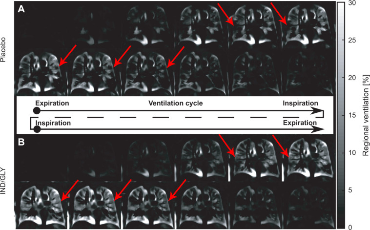 Ventilation cycle following treatment with placebo and IND-GLY in one patient. Shown is the ventilation cycle of one patient with COPD (man, 67 years old, postbronchodilator FEV1 at baseline of 31.6% and FEV1 postbronchodilator treatment of 36.7%, GOLD stage 3) following treatment with (A) placebo and (B) IND-GLY calculated with PREFUL MRI. For display purposes, the time resolution is reduced to six expiration-to-inspiration and six inspiration-to-expiration phases. Note the more homogeneous ventilation across the lungs after IND-GLY treatment as indicated by the arrows. Images were acquired without contrast agent administration using a two-dimensional gradient-echo sequence in coronal orientation. IND/GLY = indacaterol-glycopyrronium, COPD = chronic obstructive pulmonary disease, FEV1 = forced expiratory volume in 1 second, GOLD = Global Initiative for Chronic Obstructive Lung Disease, PREFUL = phase-resolved functional lung.