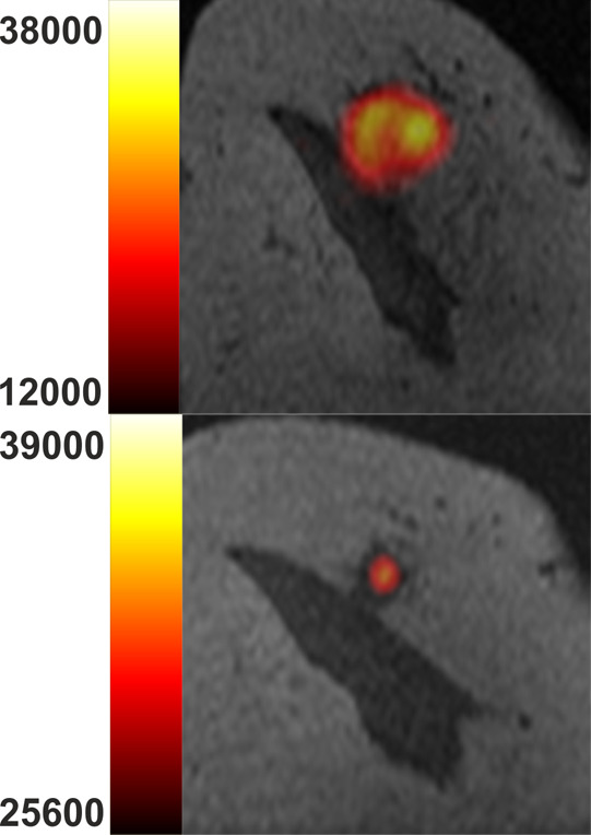 Multinuclear hydrogen 1 and 13C MR images of the right breast at baseline (top) and after one cycle of neoadjuvant chemotherapy (bottom). (a) Coronal summed hyperpolarized [1-13C]-pyruvate and (b) [1-13C]-lactate signal overlaid on unenhanced T1-weighted images. (c) Coronal dynamic contrast-enhanced MR image obtained 150 seconds after contrast agent injection and (d) overlaid transfer constant (Ktrans) map.