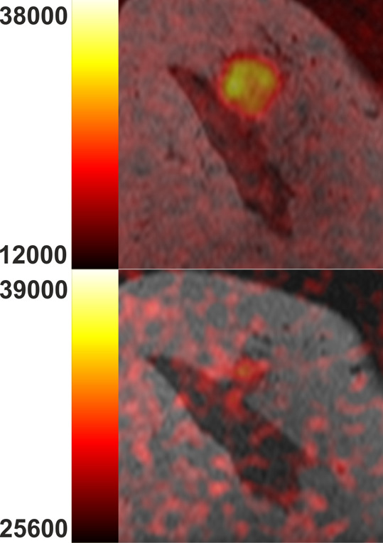 Multinuclear hydrogen 1 and 13C MR images of the right breast at baseline (top) and after one cycle of neoadjuvant chemotherapy (bottom). (a) Coronal summed hyperpolarized [1-13C]-pyruvate and (b) [1-13C]-lactate signal overlaid on unenhanced T1-weighted images. (c) Coronal dynamic contrast-enhanced MR image obtained 150 seconds after contrast agent injection and (d) overlaid transfer constant (Ktrans) map.