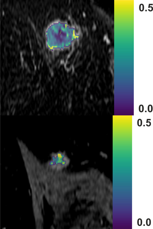 Multinuclear hydrogen 1 and 13C MR images of the right breast at baseline (top) and after one cycle of neoadjuvant chemotherapy (bottom). (a) Coronal summed hyperpolarized [1-13C]-pyruvate and (b) [1-13C]-lactate signal overlaid on unenhanced T1-weighted images. (c) Coronal dynamic contrast-enhanced MR image obtained 150 seconds after contrast agent injection and (d) overlaid transfer constant (Ktrans) map.