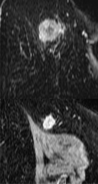 Multinuclear hydrogen 1 and 13C MR images of the right breast at baseline (top) and after one cycle of neoadjuvant chemotherapy (bottom). (a) Coronal summed hyperpolarized [1-13C]-pyruvate and (b) [1-13C]-lactate signal overlaid on unenhanced T1-weighted images. (c) Coronal dynamic contrast-enhanced MR image obtained 150 seconds after contrast agent injection and (d) overlaid transfer constant (Ktrans) map.