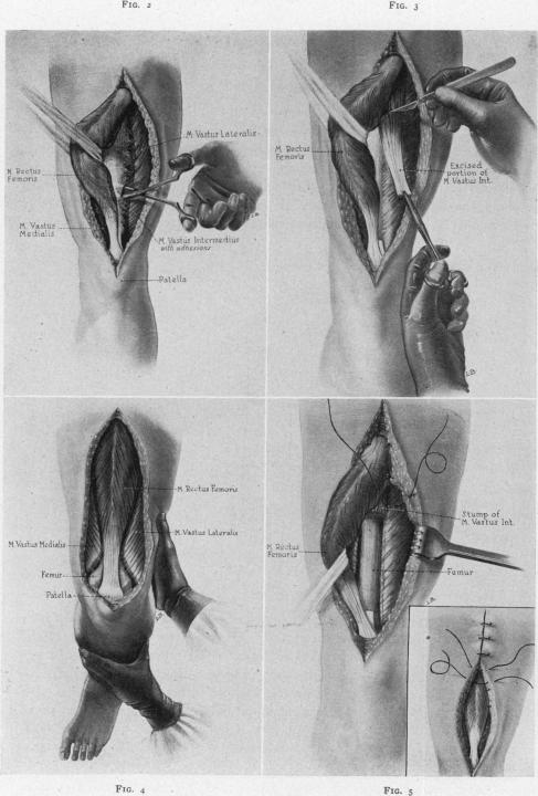 Fig. 2, 3, 4, 5.