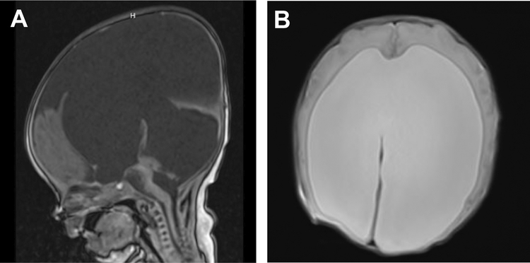 Syndromic Hydrocephalus - PMC