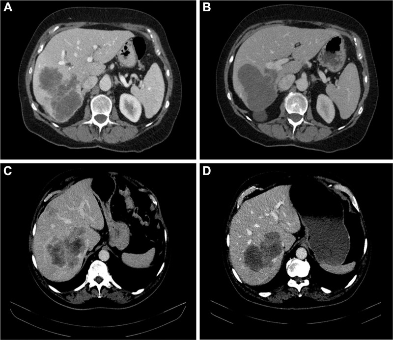 Morphologic response categories. Baseline and follow-up CT scans show (A, B) an optimal morphologic response of colorectal liver metastases with the transition of heterogeneous attenuation and ill-defined tumor–liver interface (A) to homogeneous and hypoattenuating attenuation and sharp tumor–liver interface (B) and (C, D) suboptimal morphologic response with the transition of heterogeneous attenuation and ill-defined tumor–liver interface (C) to homogeneous attenuation but ill-defined tumor–liver interface remaining after treatment (D).