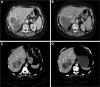 Morphologic response categories. Baseline and follow-up CT scans show
(A, B) an optimal morphologic response of colorectal liver metastases with
the transition of heterogeneous attenuation and ill-defined
tumor–liver interface (A) to homogeneous and hypoattenuating
attenuation and sharp tumor–liver interface (B) and (C, D) suboptimal
morphologic response with the transition of heterogeneous attenuation and
ill-defined tumor–liver interface (C) to homogeneous attenuation but
ill-defined tumor–liver interface remaining after treatment
(D).