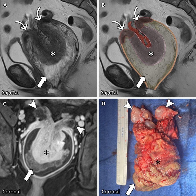 A 57-year-old postmenopausal woman with uterine inversion from adenosarcoma. (A) Sagittal T2-weighted MR image with (B) illustrated overlay, (C) coronal T1-weighted postcontrast MR image, and (D) photograph of corresponding gross pathologic findings show uterine inversion with transcervical (curved arrows) myometrial (asterisks) protrusion into the vagina. The inverted endometrium and associated frondlike enhancing mass (arrows) are located between the myometrium (asterisks) and vaginal wall (orange line in B>). Uterine inversion tethers the ovaries (arrowheads) at the level of the cervix.