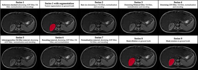 Impact of each processing step on T2-weighted MR images in a 6-year-old female patient with a right adrenal neuroblastic tumor. ADF = anisotropic diffusion filter, CFF = curvature flow filter.