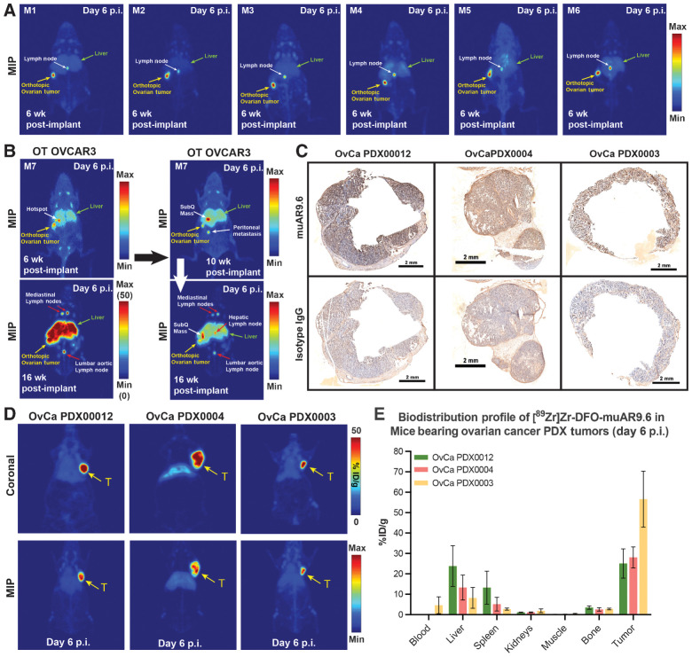 Figure 3. ImmunoPET delineates the uptake of [89Zr]Zr-DFO-muAR9.6 in orthotopic-turned-metastatic and PDX models of HGSOC. A, PET images (MIPs scaled 0–100) of female nude mice taken 6 weeks after surgical implantation of the left ovary with OVCAR3 cells. ImmunoPET imaging with 1 mg/kg of [89Zr]Zr-DFO-muAR9.6 (210 ± 11.7 μCi; 7.8 ± 0.4 MBq; 24 μg) delineated the orthotopic tumor as well as a lymph node in the hepatic region. B, Periodic immunoPET imaging of a mouse bearing an orthotopic OVCAR3 xenograft showed disease progression from the primary site of tumor cell inoculation (left ovary) to the liver and distant sites including the mediastinal lymph nodes in the thorax and the lumbar aortic lymph node in the lower abdomen. In this experiment, the mouse was injected three times with [89Zr]Zr-DFO-muAR9.6 (210 ± 11.7 μCi; 7.8 ± 0.4 MBq; 24 μg) at 6, 10, and 16 weeks after inoculation, and the images were collected 6 days after each administration of the radioimmunoconjugate. C, Cryosections of tumor tissue resected from three human patients with HGSOC showing strong immunoreactive staining with muAR9.6 relative to an isotype control IgG used for IHC. D, PET images of female NSG mice bearing three different types of subcutaneous PDX (T; n = 3 mice per PDX) injected with 1.3 mg/kg [89Zr]Zr-DFO-muAR9.6 (248 ± 5.3 μCi; 9.2 ± 0.2 MBq; 33.0 ± 4.3 μg). E, Ex vivo biodistribution data collected 6 days after 0.12 ± 0.01 mg/kg (22.7 ± 1.2 μCi; 0.84 ± 0.04 MBq; 3.0 ± 0.3 μg) [89Zr]Zr-DFO-muAR9.6 was administered intravenously to mice bearing three types of subcutaneous PDX (n = 4 mice per PDX). Detailed %ID/g values are provided in Supplementary Table S5. The maximum intensity projections have been scaled from 0% to 100%.