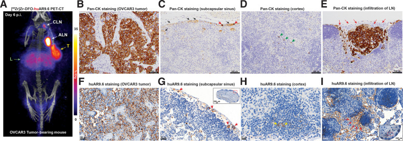 Figure 6. huAR9.6 can delineate lymph node involvement in a xenograft model of ovarian cancer. A, PET-CT image of a mouse bearing a subcutaneous OVCAR3 xenograft acquired 6 days after the intravenous injection of 2.14 mg/kg [89Zr]Zr-DFO-huAR9.6 (250 μCi; 9.25 MBq; 53 μg) showing uptake of radioactivity in the tumor (T), liver (L), and ipsilateral lymph node chain. B, Pan-cytokeratin (pan-CK) IHC staining of the OVCAR3 tumor showing a pattern of CK expression that is characteristic of epithelial cancer cells. C–E, Pan-CK IHC staining of the PET-positive IALN showing (C) immunoreactive foci of neoplastic cells (red arrowheads) and lymphatic fluid (black arrows) in the subcapsular sinuses. D, The cortex of the LN showing CK positivity in star-shaped cells (green arrowheads) indicative of dendritic cells and (E) a cluster of neoplastic cells infiltrating the IALN (red arrows) (E); F, IHC staining of the OVCAR3 tumor with huAR9.6 showing membranous staining of the OVCAR3 cells. G–I, huAR9.6 IHC staining of the PET-positive IALN (G) showing the presence of a few neoplastic cells (red arrowheads). The inset shows the appearance of the huAR9.6-stained PET-positive but H&E-negative IALN, and the red box in the inset identifies the portion shown in the main image. H, The cortex and follicles of the LN showing positivity for huAR9.6 staining in star-shaped cells (yellow arrowheads) indicative of dendritic cells. I, A cluster of neoplastic cells draining into and infiltrating the medulla of the IALN (red arrows). The inset shows the architecture and appearance of the corresponding huAR9.6-stained PET-positive but H&E-negative IALN, and the red box in the inset identifies the portion shown in the main image.