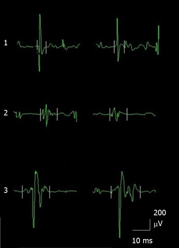 Diagnostic Value Of Orbicularis Oculi Muscle Electromyography In 