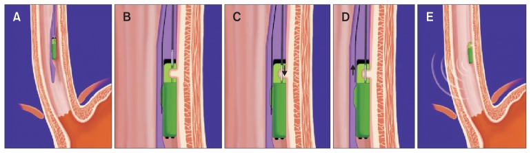 Evaluation of Gastroesophageal Reflux Disease Using the Bravo Capsule ...