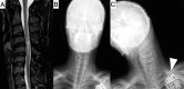 Pre- and postoperative radiological images of case 2