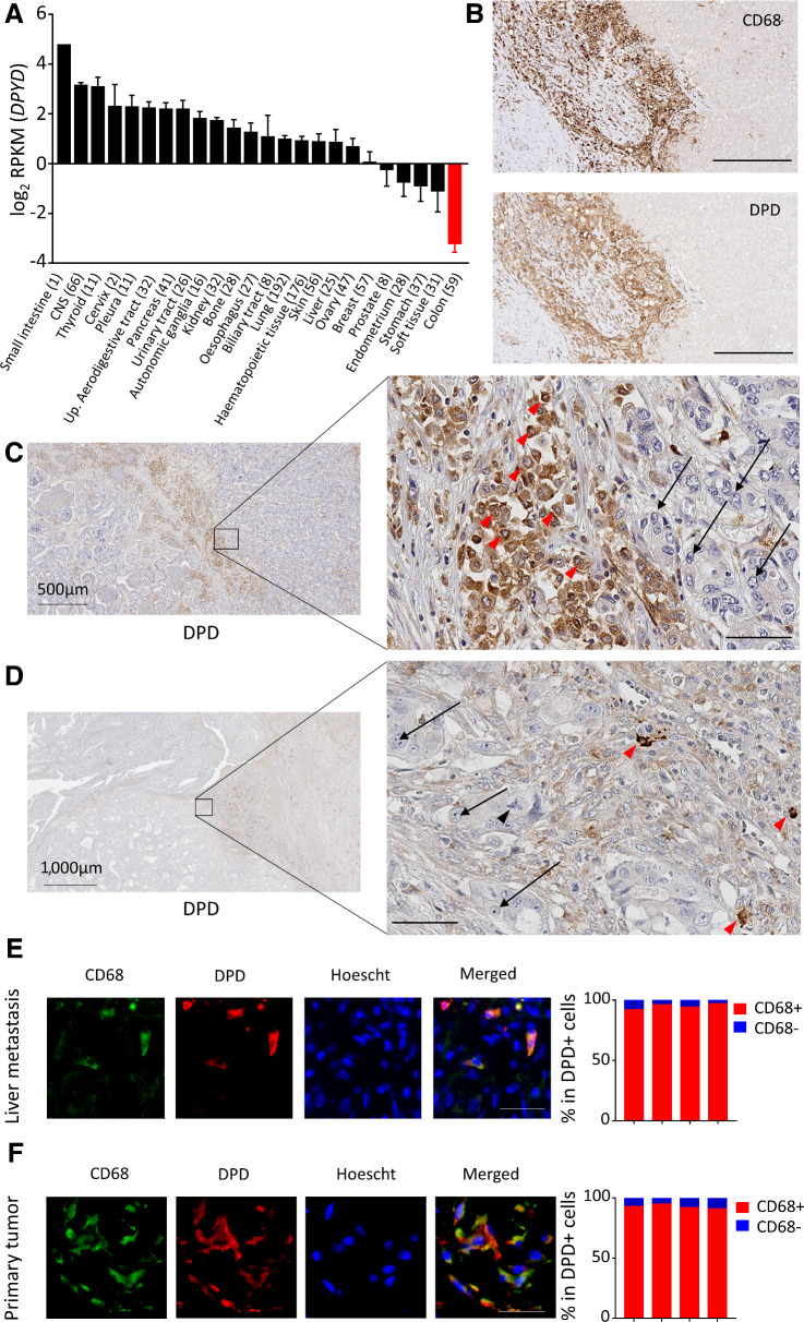 Figure 4. Macrophages harbor the main DPD expression in colorectal cancer. A, RNA-seq analysis of DPYD expression in various cancer cell lines from the CCLE. Colon cancer cell lines are in red. B, Immunochemistry analysis of CD68 (top) and DPD (bottom) expression in liver metastasis of colorectal cancer (n = 15). Scale bar, 200 μm. C, Immunochemistry analysis of DPD expression in various cell populations in liver metastasis. Red arrowheads, macrophages; black arrows, metastatic cancerous cells (n = 15; zoomed image scale bar, 60 μm). D, Immunochemistry analysis of DPD expression in primary tumors. Red arrowheads, macrophages; black arrows, cancer cells; black arrowhead, tripolar mitosis of a cancer cell (n = 15; zoomed image scale bar, 60 μm). E, Left, immunofluorescence staining in liver metastatic tissues, with CD68 in green, DPD in red, and nuclei stained by Hoescht in blue (n = 4). Scale bar, 50 μm. Right, quantification of CD68+ cells in the group of DPD-expressing cells (n = 4 patients). F, Immunofluorescence staining in primary tumors, with CD68 in green, DPD in red, nuclei stained by Hoescht in blue (n = 4). Scale bar, 50 μm. Right, quantification of CD68+ cells in the group of DPD-expressing cells (n = 4 patients).