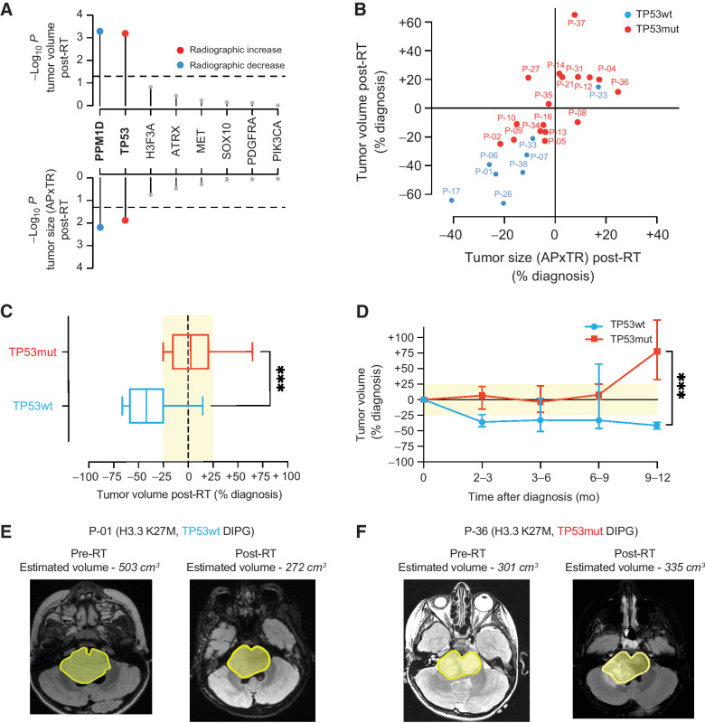 Figure 3. Somatic TP53 mutations predict poor radiographic response after radiotherapy in patients with H3K27-altered DIPG. A, Association between somatic driver gene status and change in tumor volume (top) and tumor size measured by anterior-posterior (AP) and transverse (TR) dimensions (bottom) post-RT (n = 25 H3K27-altered DIPG patients with available pre- and post-RT MRI data). Colored dots show mutant driver genes that are significantly (P < 0.05) associated with an increase (red) or decrease (blue) in tumor volume/size post-RT. B, Scatter plot comparing the percentage of change pre- and post-RT tumor volume versus tumor size across TP53mut (n = 17; red dots) and TP53wt (n = 8, blue dots) H3K27-altered DIPG. C, Box plot comparing tumor volumes stratified by TP53 mutation status based on post-RT MR images in patients enrolled in PNOC003 (TP53mut, n = 17, red box; TP53wt, n = 8, blue box). D, Line graph showing longitudinal changes in tumor volume from time of initial diagnosis up to 12 months from subjects enrolled in PNOC003 based on volumetric tumor assessment on MRI (n = 99 MRI scans; TP53mut, n = 17, red line; TP53wt, n = 8, blue line). E and F, show a representative example of pre- and post-RT MRI tumor volume for patients with a TP53wt (C) and TP53mut (F) H3.3 K27M-mutant DIPG. Yellow area marks tumor outline. RT, radiotherapy; wt, wild-type; mut, mutant; MRI, magnetic resonance imaging; AP, anterior–posterior; TR, transverse.