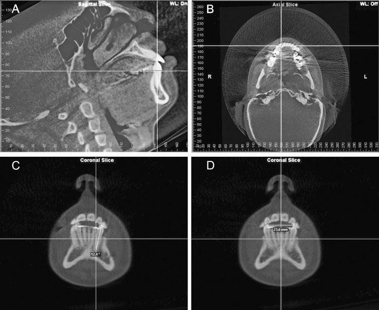 Figure 1. Measuring the buccolingual inclination of mandibular canines and the intercanine distance. (A) The sagittal slice is rotated until the coronal (vertical) line is superimposed on the long axis of the canine. (B) In the axial slice, the sagittal (vertical) and coronal (horizontal) lines are set to intersect in the center of the canine. (C) In the coronal slice, the cusp tip and the apex are connected to form a line that reflects the long axis of the canine. The sagittal (vertical) line is moved until it intersects at the center of the apex. The angular measurement between the lines is positive if the canine is tipped buccally and negative if it is tipped lingually. (D) The intercanine distance is measured in the coronal slice as the linear distance between the canine cusp tips.