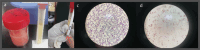 (A) Pinkish turbid fluid immediately after pericardiocentesis (B) settling of red blood cells after centrifugation, leaving milky white turbid fluid with classical appearance of chyle; (C) lymphocyte predominance on microscopy, (D) with fat stain of supernatant fluid positive for fat globules
