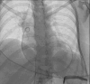 Fluoroscopic image of pigtail catheter in situ in the pericardial cavity