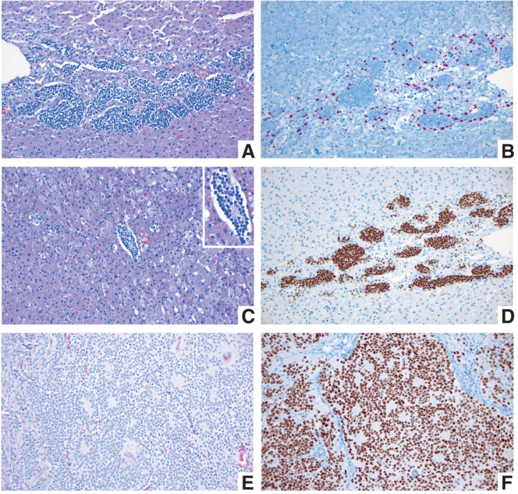 Figure 2. A–D, Fetal adrenal gland at 21–22 weeks of gestation. A, Migrating neural crest cells penetrate through the mesodermally derived fetal adrenal cortex homing into the future adrenal medulla (H&E; original magnification 200×). B, SOX10 IHC stain highlights the nuclei of migrating neural crest cells at the periphery of the migratory clusters, representing future Schwann cell precursors (SOX10 IHC; original magnification 200×). C, Migrating neural crest cells forming a Homer Wright rosette, indistinguishable from a similar structure in a poorly differentiated neuroblastoma (see E and F). The Homer Wright rossete is shown in the center, surrounded by fetal adrenal cortex (H&E; original magnification 200×). Inset shows the nonneoplastic Homer Wright rossete at a higher magnification (400×). Note the fine cytoplasmic prolongations of the future adrenal medullary cells in the center of the rosette. D, PHOX2B IHC stain showing strong nuclear reactivity in the migrating neural crest cells of the future fetal adrenal medulla (PHOX2B IHC; original magnification 200×). E and F, Poorly differentiated neuroblastoma from a 1-year-old patient. E, Several Homer Wright rosettes are seen with their characteristic central area of neuropil (H&E; original magnification 200×). F, PHOX2B IHC stain highlighting the nuclei of the neoplastic neural crest cells (neuroblasts) in multiple Homer Wright rosettes (PHOX2B IHC; original magnification 200×).