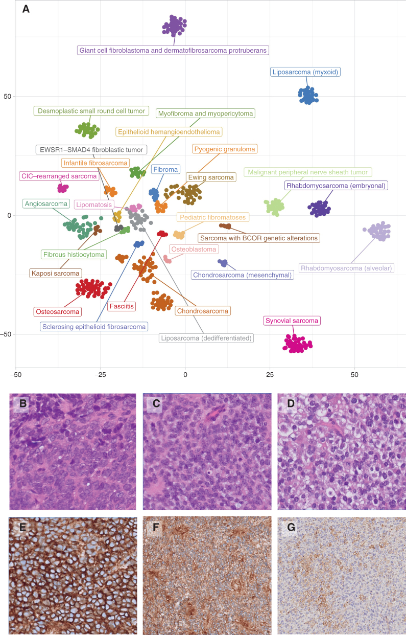 Figure 1. A, Intertumoral heterogeneity of soft-tissue and bone tumors as assessed by DNA methylation array. Unsupervised, nonlinear t-distributed stochastic neighbor embedding projection of methylation array profiles of 610 soft-tissue and bone tumor samples. Samples have been selected from a large database of sarcoma datasets to serve as reference profiles for training a supervised classification model based on strict criteria. B–G, Undifferentiated small round cell sarcomas of bone and soft tissue. B, Ewing sarcoma with EWSR::FLI 1 fusions. C, Soft-tissue sarcoma with BCOR alteration (BCOR::MAML3 fusion). D, CIC::DUX4 sarcoma. CD99 membranous staining varies from strong and diffuse in ES (E) and BCOR::MAML (F) to focal in CIC::DUX4 (G).