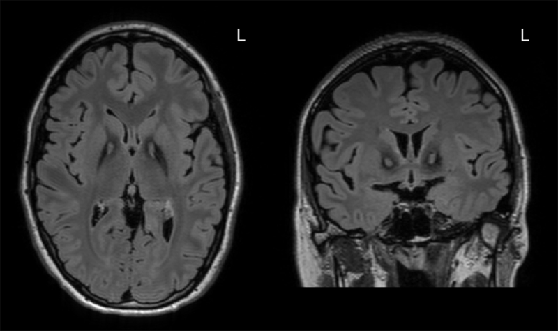 Pantothenate kinase-associated neurodegeneration (PKAN) T2 FLAIR brain MRI