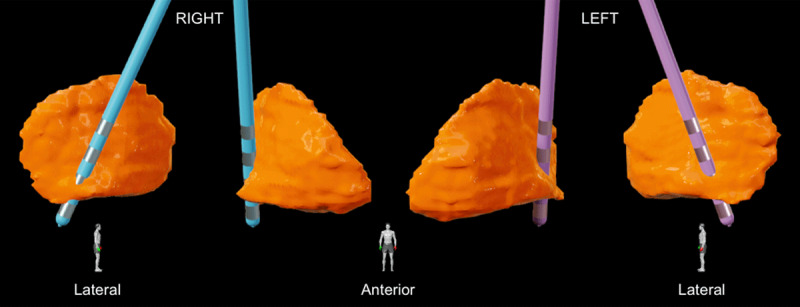 Globus pallidus internus (GPi) deep brain stimulation (DBS) lead localization