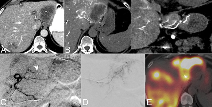 Images from CT during hepatic arteriography (CTHA) to identify hepaticoenteric collaterals not seen on digital subtraction angiography (DSA) images. (A) Multifocal colorectal liver metastasis to both hepatic lobes (*). (B) Axial and coronal CTHA reconstructions demonstrate an accessory right gastric artery arising from segment II arterial branch. (C) Pre-embolization DSA from the left hepatic artery. On the basis of CTHA images, the arterial branch consisting of the accessory right gastric artery was identified (arrowhead). (D) Selective DSA image depicts the right gastric artery, which was selected and embolized with coils. (E) Image from SPECT-CT with technetium 99m macroaggregated albumin (99mTc-MAA) obtained after embolization of the accessory right gastric artery shows lack of gastric 99mTc-MAA deposition.