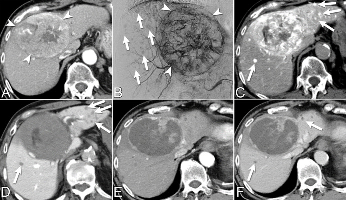 Multiple incidental small hepatocellular carcinomas (HCCs) detected with CT during hepatic arteriography (CTHA) and CT arterial portography (CTAP) during transarterial chemoembolization (TACE) for a patient presenting with a recurrent HCC. (A) Diagnostic quadriphasic contrast-enhanced CT performed 3 weeks before TACE shows solitary large central HCC (arrowheads). (B) Pre-TACE digital subtraction angiographic image from the common hepatic artery shows large hypervascular tumor (arrowheads) and small hypervascular nodules of unclear clinical significance (arrows). (C, D) CTHA and CTAP demonstrate multiple small hypervascular tumors with portal venous washout (arrows), compatible with incidental HCCs. (E, F) One month post-TACE follow-up contrast-enhanced CT arterial phase and portal venous phase scans help confirm treated large HCC and satellite hypovascular nodules (arrows in F). The ability to obtain arterial and portovenous images with combined angio-CT systems allows prompt differentiation between true HCCs and other regenerative and dysplastic liver nodules.
